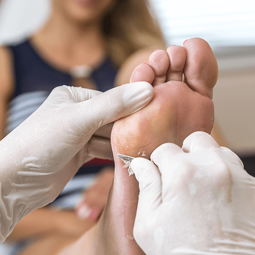 General podiatry services including removal of dead skin, wart treatments and more.