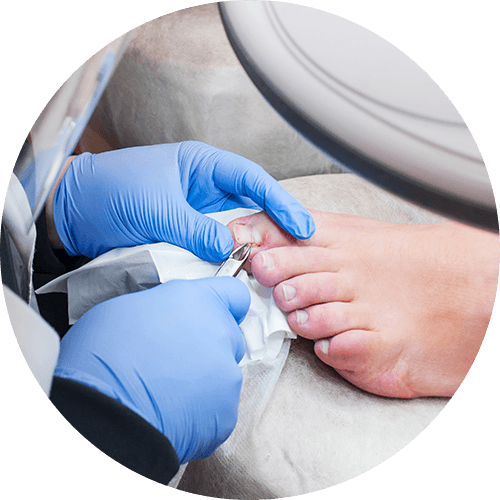 Dapto Podiatrist removes calluses, corns and treats ingrown nail.